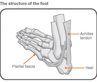 plantar fasciitis and achilles tendonitis