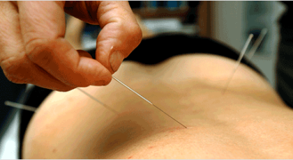 acupuncture-530x