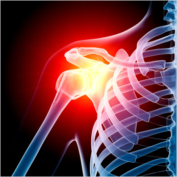 xray-shoulder-pain-graphic | The Chartered Society of Physiotherapy